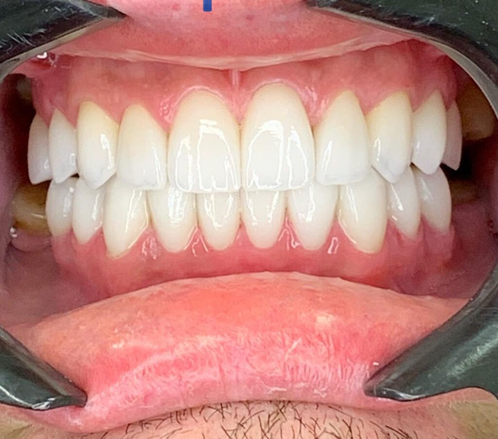 Tratamento odontológico com alinhadores invisíveis Invisalign na clínica Inovva Odonto em Perdizes São Paulo
