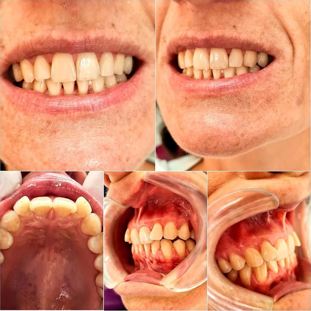 Tratamento odontológico com alinhadores invisíveis Invisalign na clínica Inovva Odonto em Perdizes São Paulo