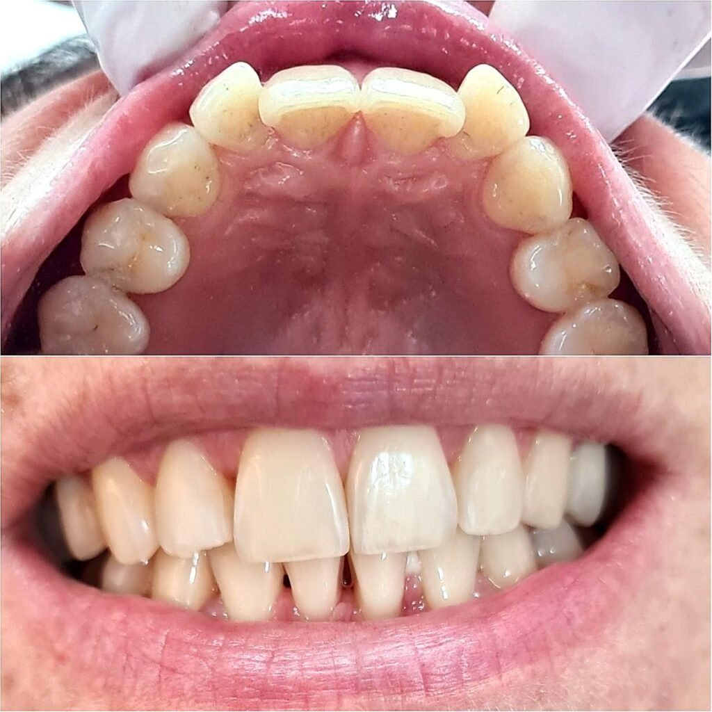 Tratamento odontológico com alinhadores invisíveis Invisalign na clínica Inovva Odonto em Perdizes São Paulo
